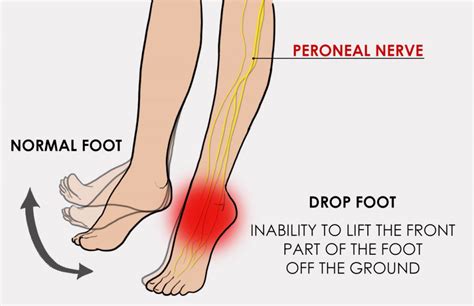 toe drop test|foot drops on top of foot.